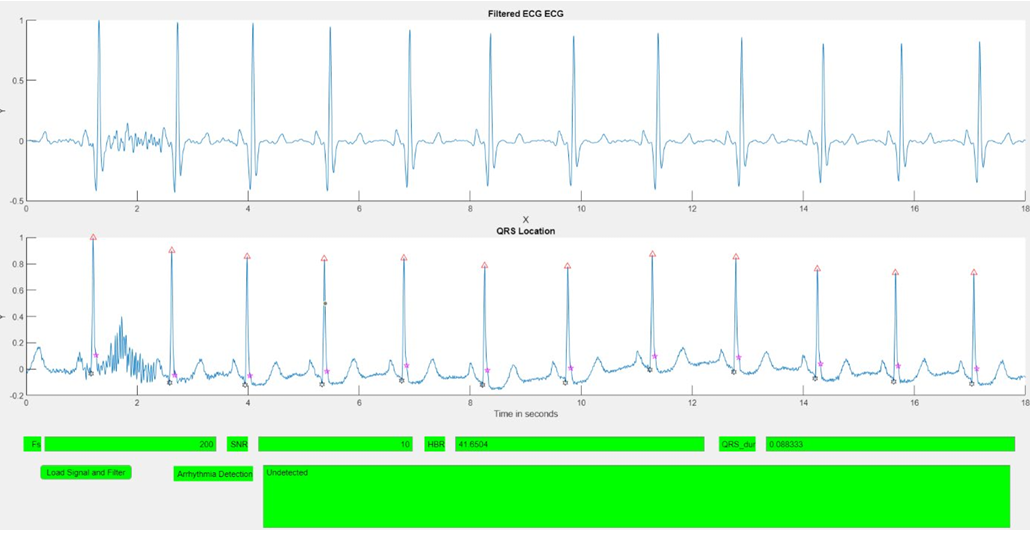 ECG Waveform for QRS Detection